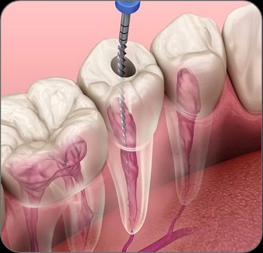 Endodonti